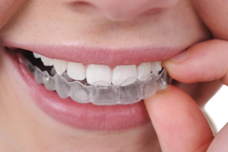 Invisalign Clear Braces Toronto, Teeth Straightening