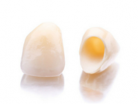 Example of Dental Crowns